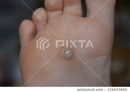 Plantar wart on a child's foot. Papillomavirus Plantar wart on a child's foot. Papillomavirus 126645668