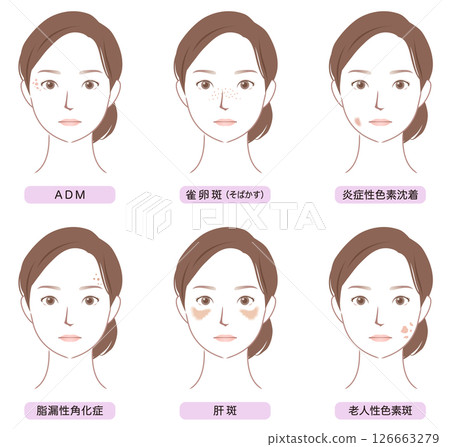 臉部斑點的類型 美容女性 126663279
