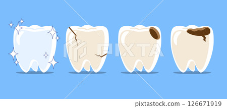 Healthy teeth, Cracked tooth, dental caries or tooth decayed . Set of flat design cartoon illustration . Isolated on Blue background . Vector . 126671919