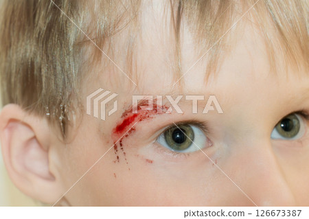 boy with a head wound 126673387