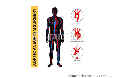 Thoracic aortic aneurysm open surgery 126686999