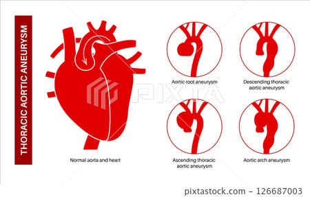Thoracic aortic aneurysm 126687003