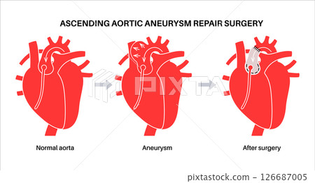 Thoracic aortic aneurysm open surgery 126687005