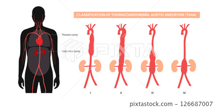 Thoracoabdominal aortic aneurysm 126687007