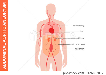 Abdominal Aortic Aneurysm 126687017