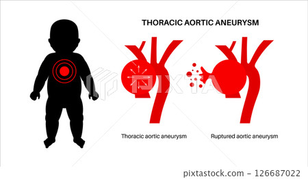 Ruptured thoracic aortic aneurysm 126687022