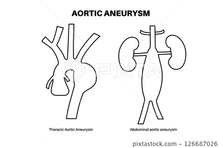 Aortic Aneurysm Types Aortic Aneurysm Types 126687026