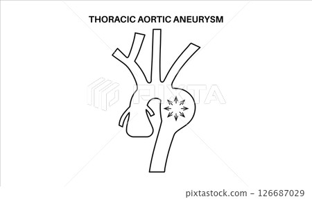 Thoracic aortic aneurysm 126687029