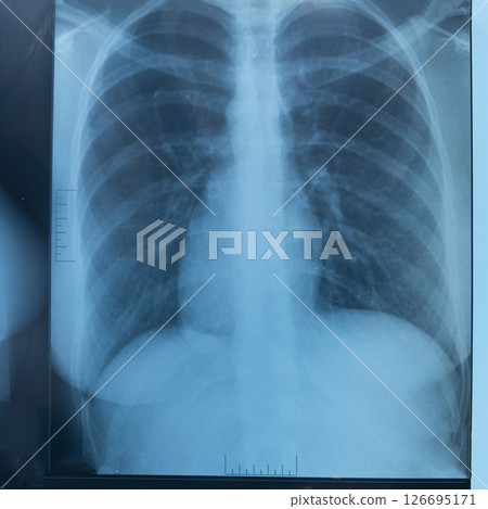 Human lung x-ray analysis, doctor examines lung disease. Pneumonia. Lung x-ray isolated on white background. Human lung x-ray analysis, doctor examines lung disease. Pneumonia. Lung x-ray isolated on white background. 126695171