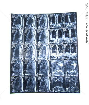 MRI xray film scan of sacro-lumbar spines of a patient with chronic back pain MRI xray film scan of sacro-lumbar spines of a patient with chronic back pain 126695226