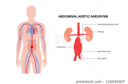 Abdominal Aortic Aneurysm 126695907