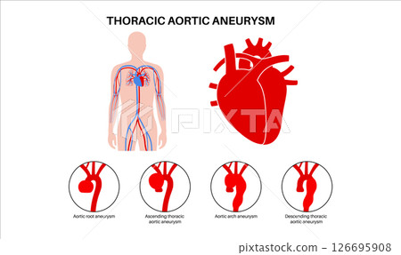 Thoracic aortic aneurysm 126695908