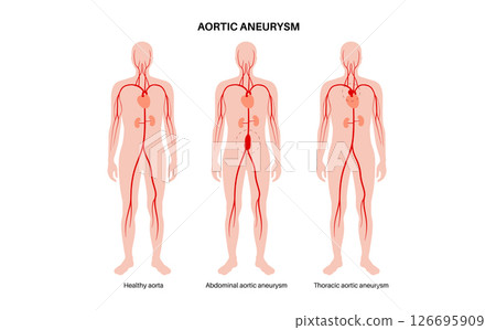 Abdominal Aortic Aneurysm Abdominal Aortic Aneurysm 126695909