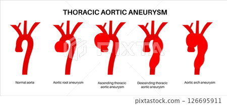 Thoracic aortic aneurysm 126695911