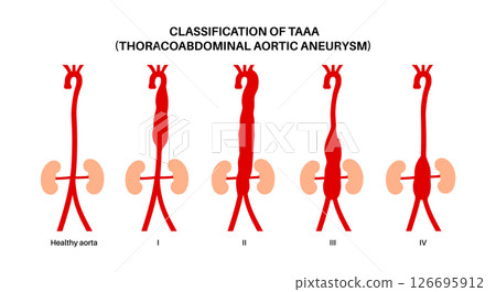 Thoracoabdominal aortic aneurysm 126695912