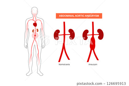 Abdominal Aortic Aneurysm 126695913