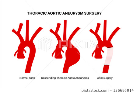 Thoracic aortic aneurysm open surgery 126695914
