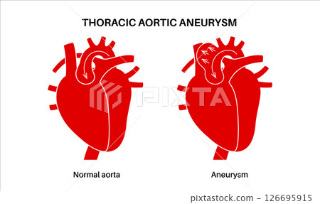 Thoracic aortic aneurysm 126695915