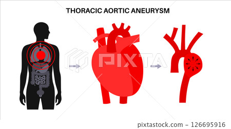 Thoracic aortic aneurysm 126695916