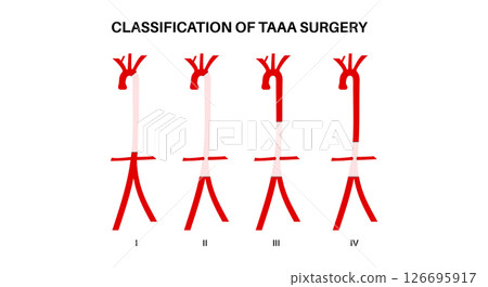 Thoracoabdominal aortic aneurysm surgery Thoracoabdominal aortic aneurysm surgery 126695917