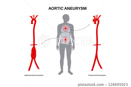 Abdominal Aortic Aneurysm Abdominal Aortic Aneurysm 126695923