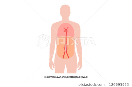 Abdominal Aortic Aneurysm Abdominal Aortic Aneurysm 126695933