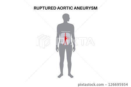 Abdominal Aortic Aneurysm 126695934