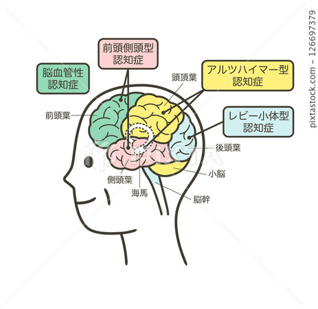 Illustration of the parts of the brain that are damaged by dementia in the elderly and their names Illustration of the parts of the brain that are damaged by dementia in the elderly and their names 126697379