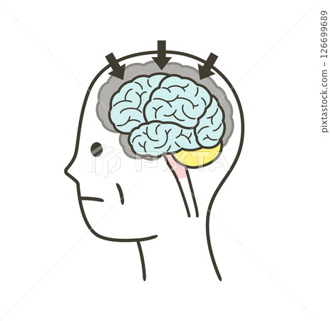 一組因阿茲海默症而受損的大腦部分的插圖 126699689