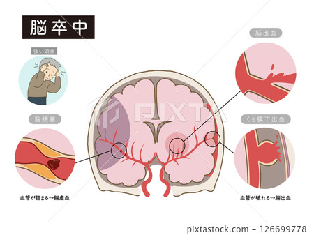 展示中風主要症狀和腦血管狀態的解剖圖 126699778