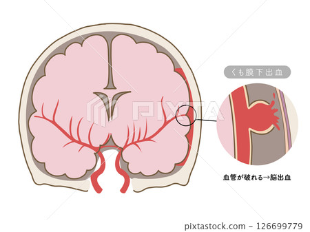 展示中風主要症狀和腦血管狀態的解剖圖 126699779