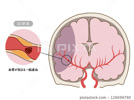 Anatomical illustrations showing the main symptoms of stroke and the state of cerebral blood vessels 126699780