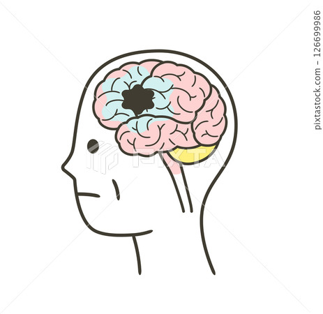 Illustration of parts of the brain damaged by vascular dementia Illustration of parts of the brain damaged by vascular dementia 126699986