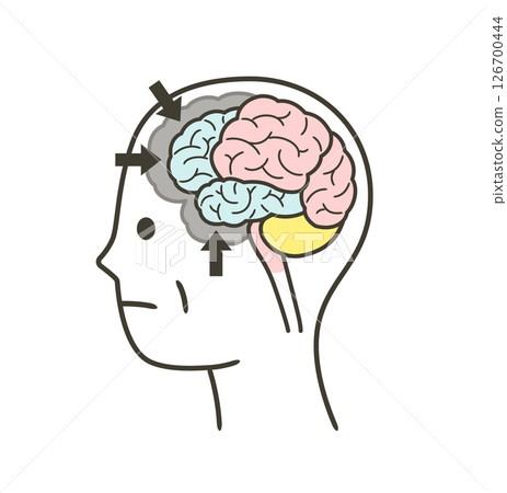 Illustration of parts of the brain damaged by frontotemporal dementia Illustration of parts of the brain damaged by frontotemporal dementia 126700444