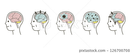 A set of illustrations of parts of the brain and their names that are damaged by dementia in the elderly A set of illustrations of parts of the brain and their names that are damaged by dementia in the elderly 126700708