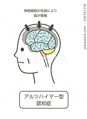 一組因阿茲海默症而受損的大腦部位及其名稱的插圖 126701159