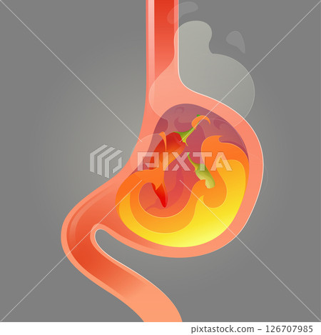 A fiery stomach inflamed by chili a striking image of how spicy food can trigger acid reflux. A fiery stomach inflamed by chili a striking image of how spicy food can trigger acid reflux. 126707985