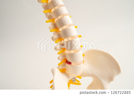 Lumbar spine displaced herniated disc fragment, spinal nerve and bone. Model for treatment medical in the orthopedic department. Lumbar spine displaced herniated disc fragment, spinal nerve and bone. Model for treatment medical in the orthopedic department. 126722885