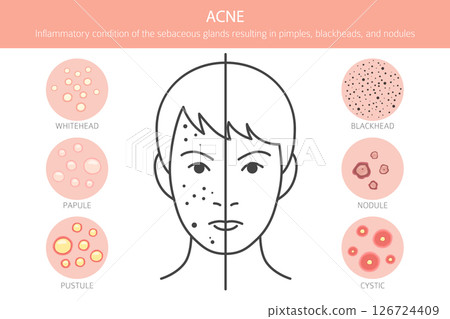 Acne skin condition. Skin diseases. Medical infographic design Acne skin condition. Skin diseases. Medical infographic design 126724409