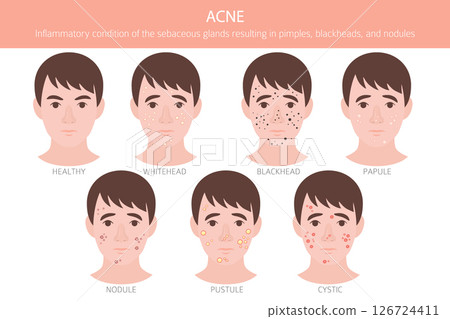 Acne skin condition. Skin diseases. Medical infographic design 126724411