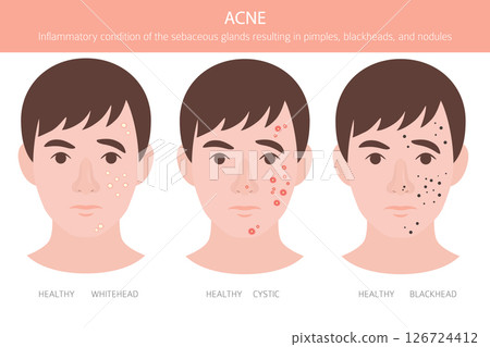 Acne skin condition. Skin diseases. Medical infographic design 126724412