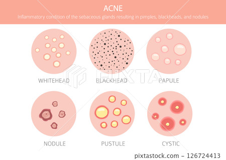 Acne skin condition. Skin diseases. Medical infographic design 126724413