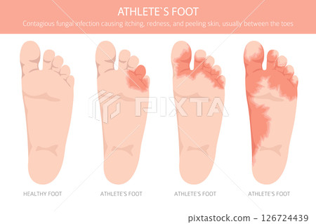 Athlete`s foot. Tinea pedis skin condition. Skin diseases. Medical infographic design 126724439