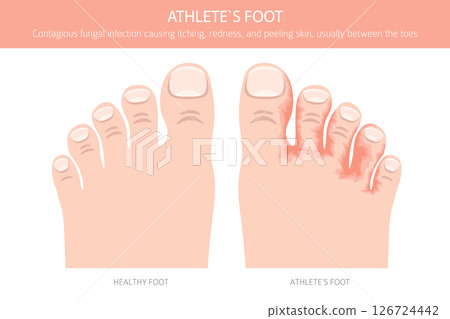 Athlete`s foot. Tinea pedis skin condition. Skin diseases. Medical infographic design 126724442