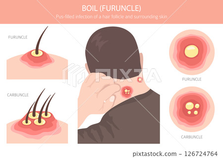 Boil, Furuncle, carbuncle. Skin diseases. Medical infographic design 126724764