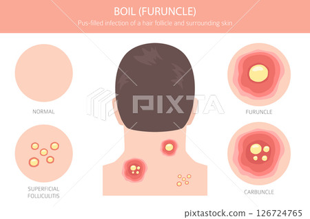 Boil, Furuncle, carbuncle. Skin diseases. Medical infographic design 126724765