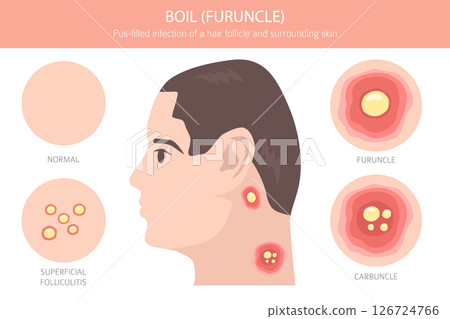 Boil, Furuncle, carbuncle. Skin diseases. Medical infographic design 126724766
