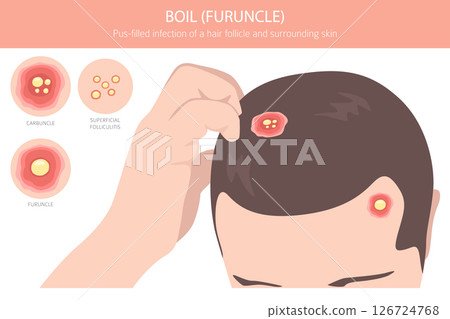 Boil, Furuncle, carbuncle. Skin diseases. Medical infographic design Boil, Furuncle, carbuncle. Skin diseases. Medical infographic design 126724768