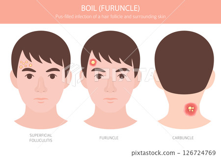 Boil, Furuncle, carbuncle. Skin diseases. Medical infographic design 126724769