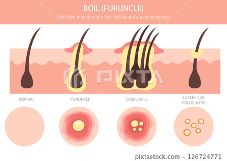 Boil, Furuncle, carbuncle. Skin diseases. Medical infographic design Boil, Furuncle, carbuncle. Skin diseases. Medical infographic design 126724771